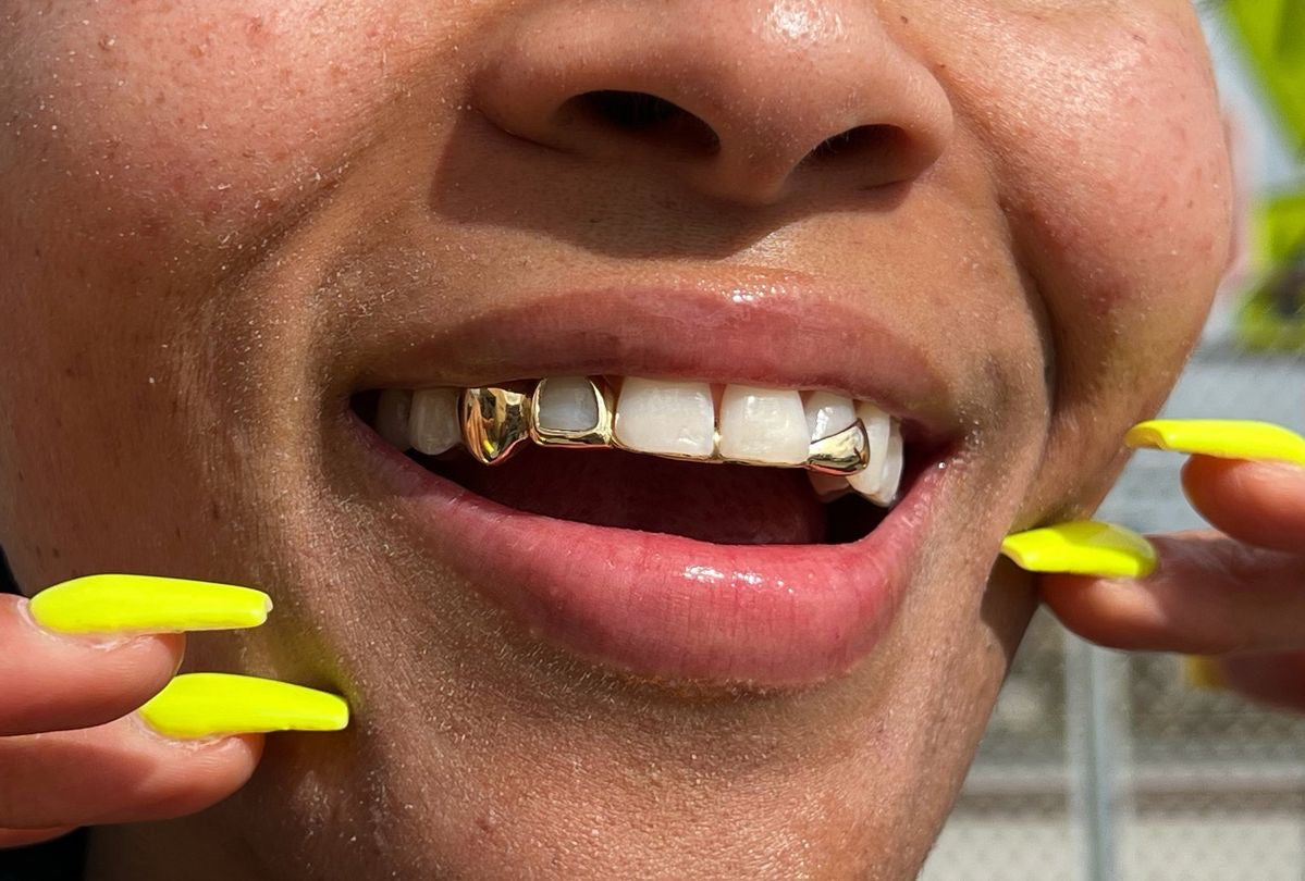 Prix Grillz en Or : Combien Coûte un Grillz Sur Mesure en France ?
