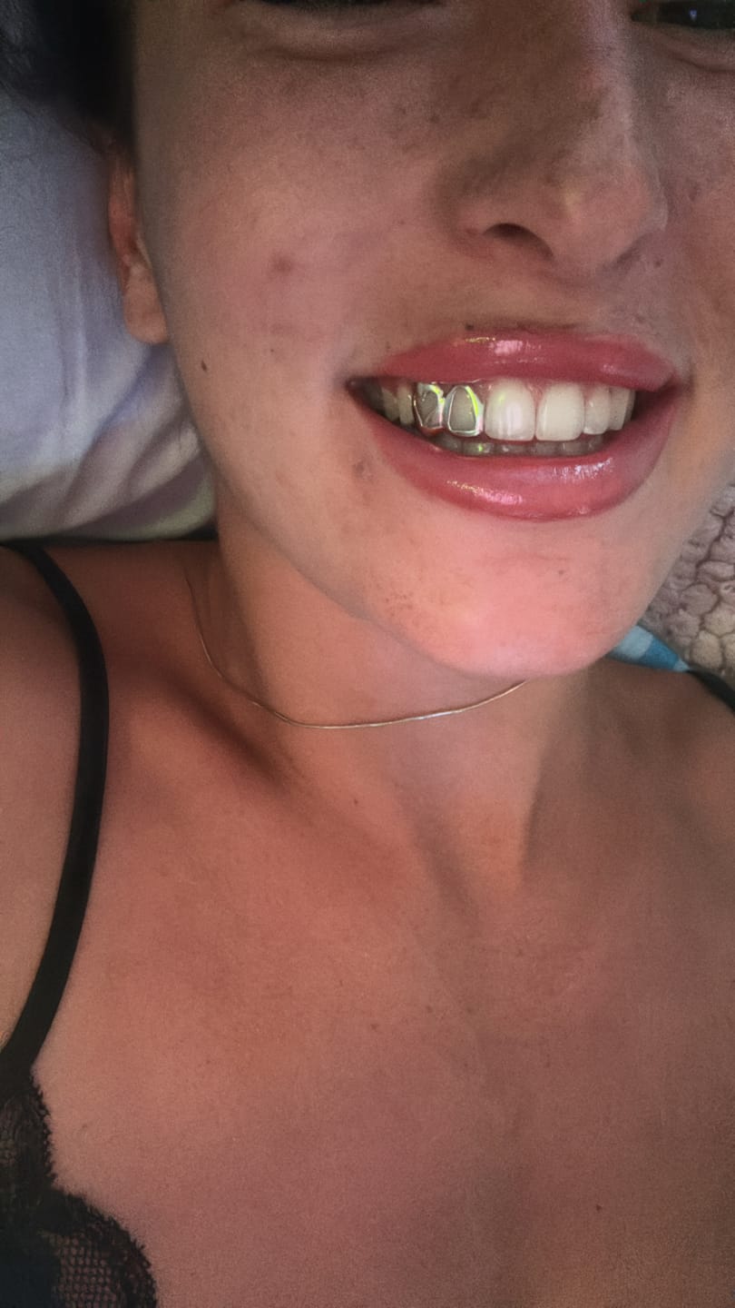 Grillz Sverige | Guld & Silverfärgade Grillz – Grillz Worldwide