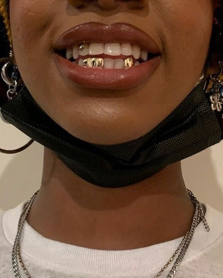 Grillz Nancy : Création de grillz sur mesure à distance avec Grillz Worldwide (2026)