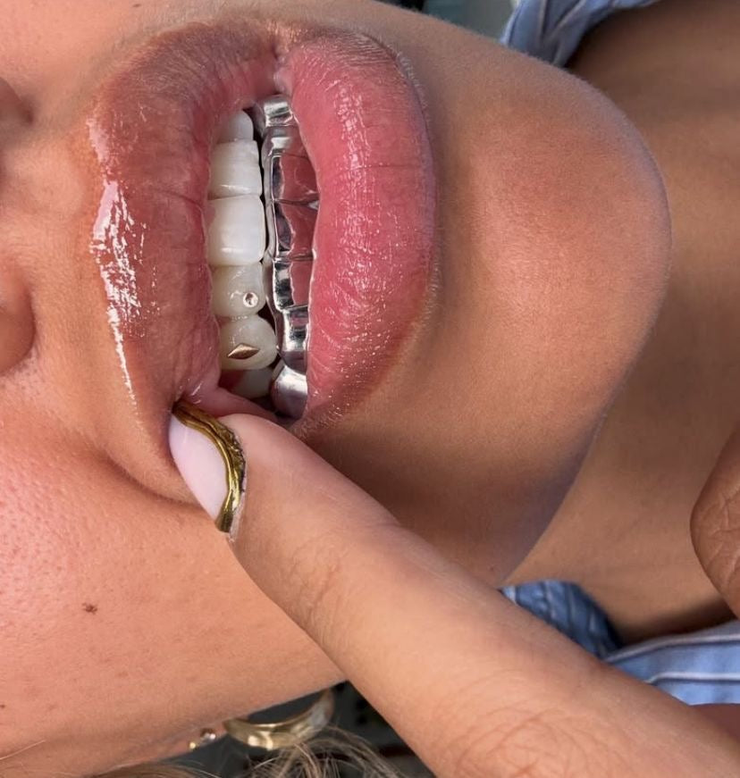 Grillz Cahors & Aurillac : Création de grillz sur mesure avec Grillz Worldwide (2026)