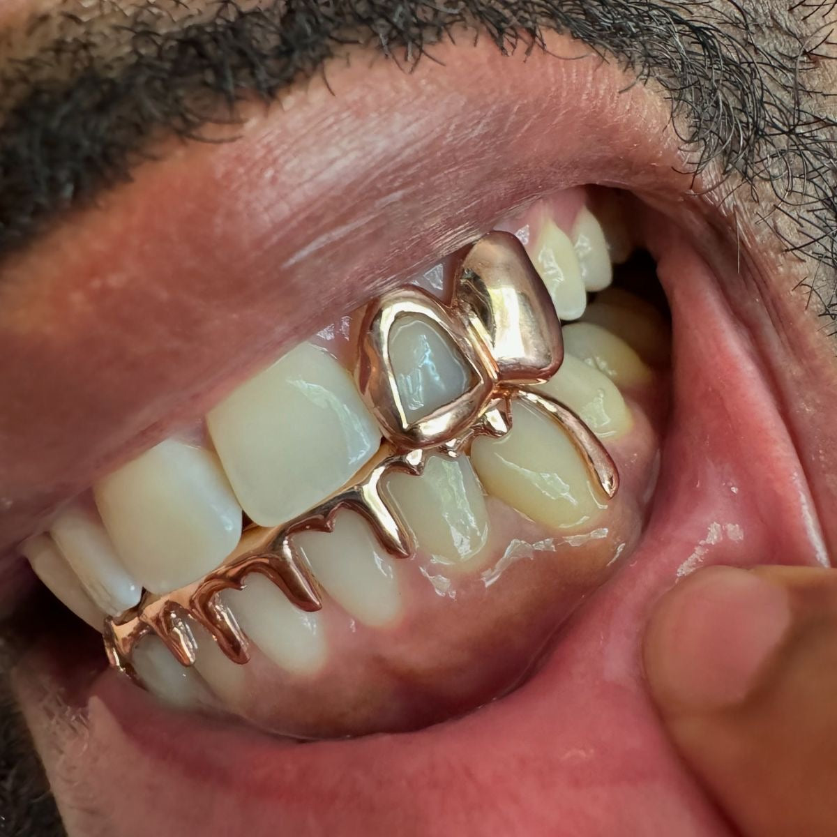 Grillz Sur Mesure : Le Guide Complet des Grillz en France, en Andorre et à Distance