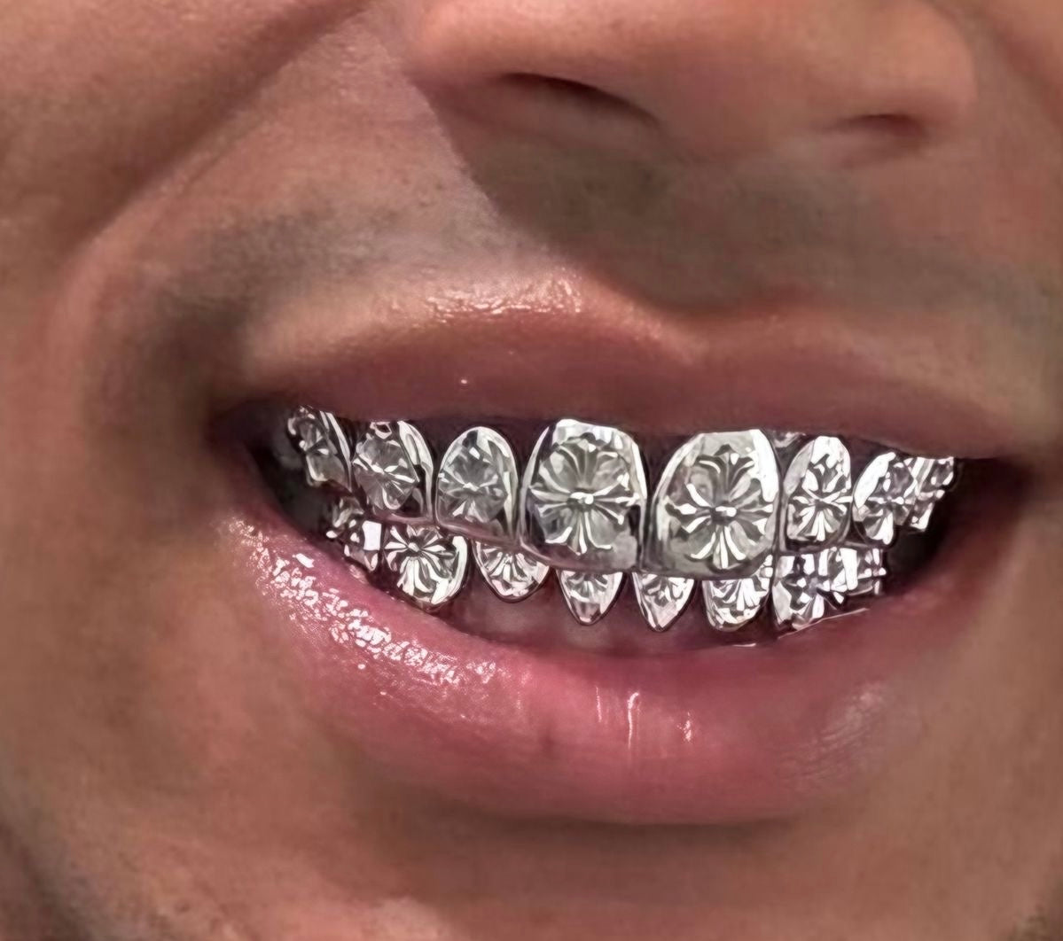 Grillz Monaco : Le Bijou Dentaire de Luxe Qui Séduit Monte-Carlo